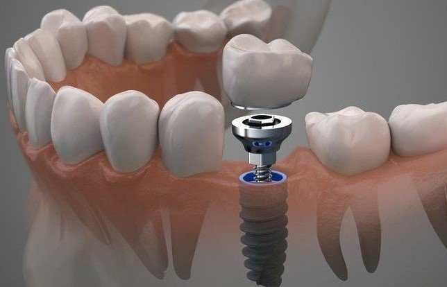 Benefits of Dental Implants