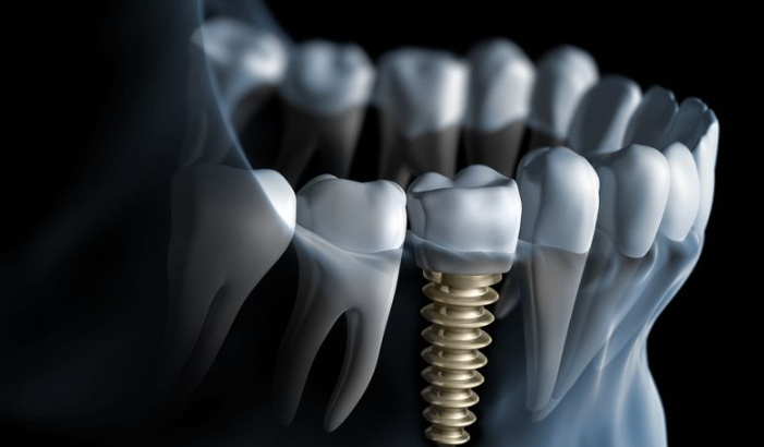 Dental Implants